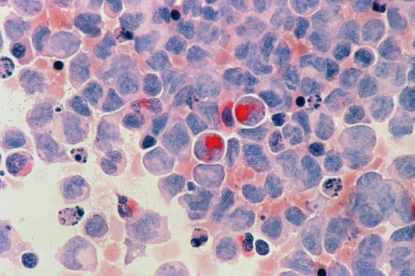 How Our Dad Is Outliving Cancer